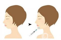 什么是自體脂肪隆下巴?自體脂肪填充下巴原理是什么?