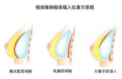 哪些人適合隆胸?隆胸前要做哪些準(zhǔn)備?