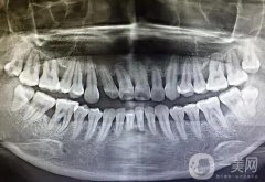牙槽骨修整術(shù)的適應(yīng)癥和術(shù)后護(hù)理