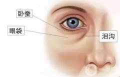 去除臥蠶嗎？臥蠶后的注意事項(xiàng)有哪些？