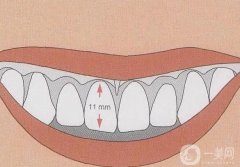 什么是牙冠延長？牙冠延長術(shù)的手術(shù)方法