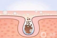 毛孔粗大會(huì)給自己帶來什么樣的后果?如何改良毛孔粗大的皮膚呢?