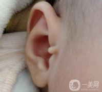 附耳什么時(shí)候被切除好?