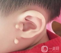 附耳切除術(shù)的手術(shù)過(guò)程以及禁忌人群有哪些呢?