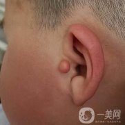 附耳切除對(duì)聽(tīng)力有害嗎?