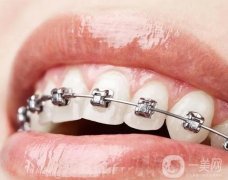 固定矯治器調(diào)節(jié)的優(yōu)勢(shì)？注意事項(xiàng)？