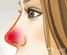 酒糟鼻會復發(fā)嗎？會復發(fā)的原因是什么？