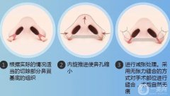 如果鼻翼縮小手術(shù)失敗了怎么辦？鼻翼縮小手術(shù)是如何進(jìn)行的？