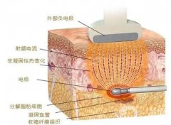射頻緊膚適合哪些人群？果怎么樣？