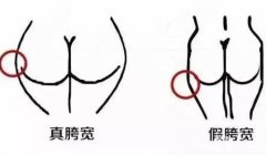 假胯寬能不能抽脂？如何判斷自己是不是假胯寬？