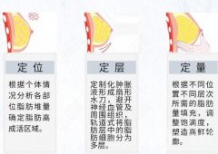 脂肪豐胸可以維持多長時間?脂肪豐胸的恢復時間是多久?