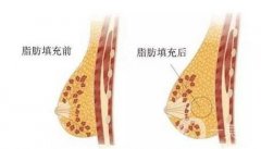 脂肪隆胸需要多久才能塑形?脂肪隆胸多久能恢復(fù)?脂肪豐胸后需要注意什么?