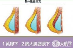 隆胸手術(shù)的價(jià)格是多少?隆胸手術(shù)果如何?
