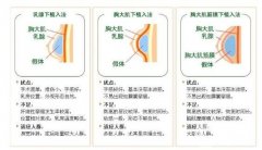 重慶豐胸多少錢?隆胸手術(shù)好嗎?