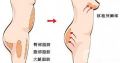 自體脂肪豐胸的價(jià)格是多少?