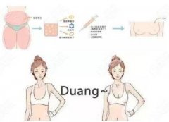 抽脂隆胸一般要多少錢?抽脂隆胸貴嗎?