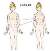 自體脂肪隆胸二次費用多少?影響成本的因素有哪些?