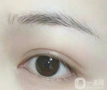 雙眼皮全切修復(fù)多少錢?雙眼皮全切修復(fù)需要多長(zhǎng)時(shí)間?