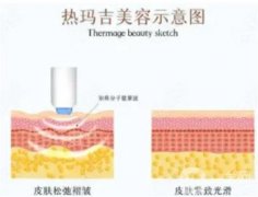 熱瑪吉會不會反彈？果可以管多久？