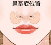 如何填充鼻基底凹陷才不會老？