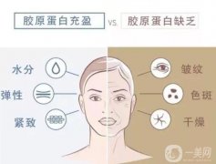 膠原蛋白注射后果能持續(xù)多久？膠原蛋白和玻尿酸的區(qū)別？