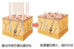 點陣激光的作用及危害？價格怎么樣？