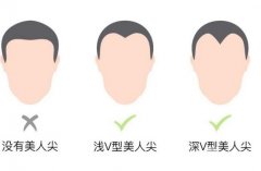 種植美人尖的成活率是多少？種植美人尖的好處？