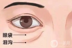 自體脂肪填充淚溝的恢復(fù)過程是怎樣的？痛不痛？