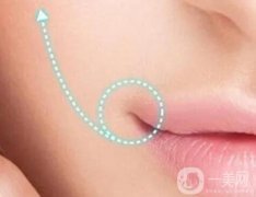 嘴角上揚(yáng)手術(shù)適合誰？有什么危害
