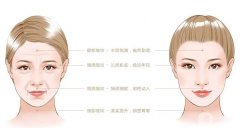射頻緊致皮膚一次多少錢？有什么注意事項(xiàng)？