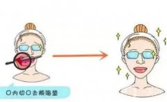 去頰脂墊手術(shù)價(jià)格的影響因素？手術(shù)果如何？
