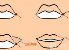 嘴角上揚手術(shù)會不會留疤？恢復(fù)期是多久？