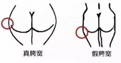 假胯寬能抽脂解決嗎？如何判斷自己是不是假胯寬？