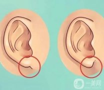 玻尿酸豐耳垂的副作用和危害？