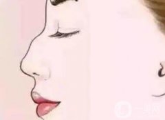 矯正駝峰鼻能維持多久？是*的嗎？