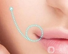 嘴角上揚手術(shù)是不是*的？手術(shù)有風險嗎？