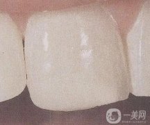 復(fù)合樹脂粘結(jié)修復(fù)的優(yōu)勢是什么？