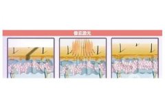 像素激光和點(diǎn)陣激光有哪些區(qū)別？