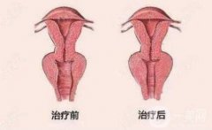 陰道整形到底是什么?包括哪些項目?