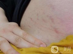 妊娠紋幾個月開始出現(xiàn)?