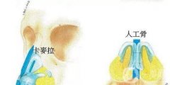 人工骨隆鼻好還是肋骨鼻好?詳細(xì)看過(guò)來(lái)