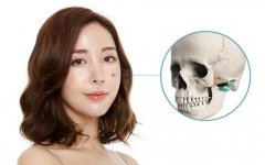 顴骨整形后應(yīng)該如何護(hù)理?感染了怎么辦?
