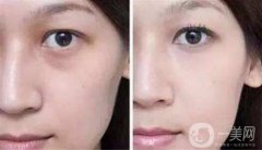 去眼袋魚(yú)尾紋小妙招