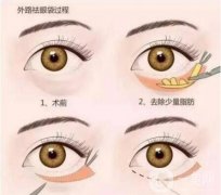 去眼袋魚(yú)尾紋手術(shù)價(jià)格是多少錢(qián)?