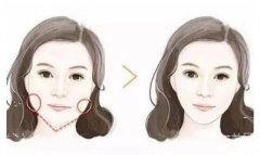 去頰脂墊恢復(fù)期是多久?過(guò)程需要注意哪些?
