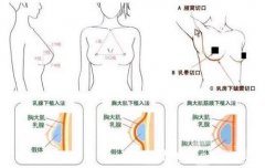淺談選擇假體隆胸和脂肪隆胸需要注意的幾點(diǎn)問題