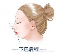 后縮下顎角整形能帶來(lái)多大改變?
