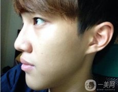 男生鼻梁不高怎么辦?可以捏高嗎?