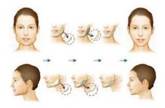磨腮價(jià)格多少錢?看看自己有沒(méi)有磨腮的必要