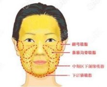 面部抽脂多久消腫?多久能恢復(fù)?